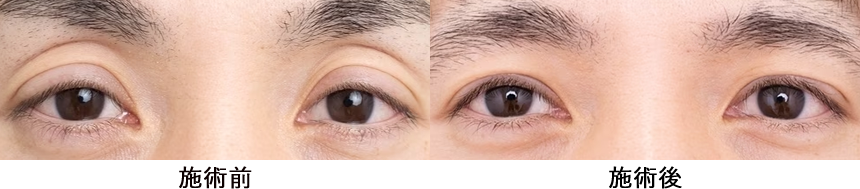 眼瞼下垂の症例写真3