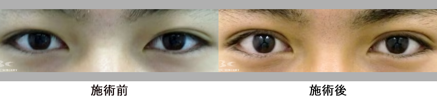 眼瞼下垂の症例写真4