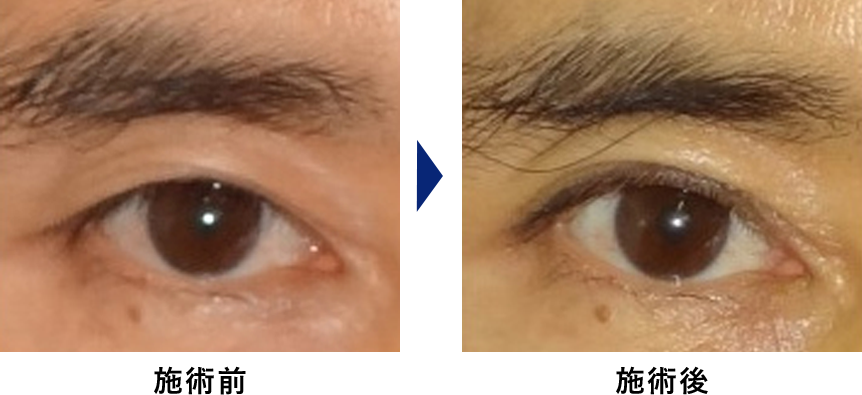 眼瞼下垂の症例写真1