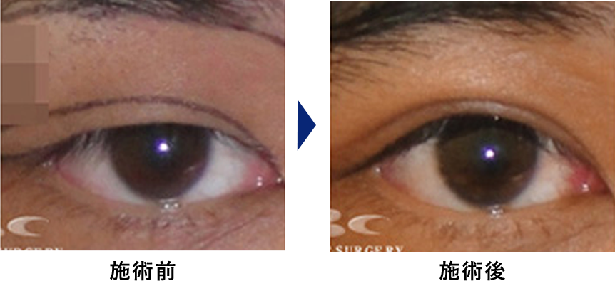 眼瞼下垂の症例写真2