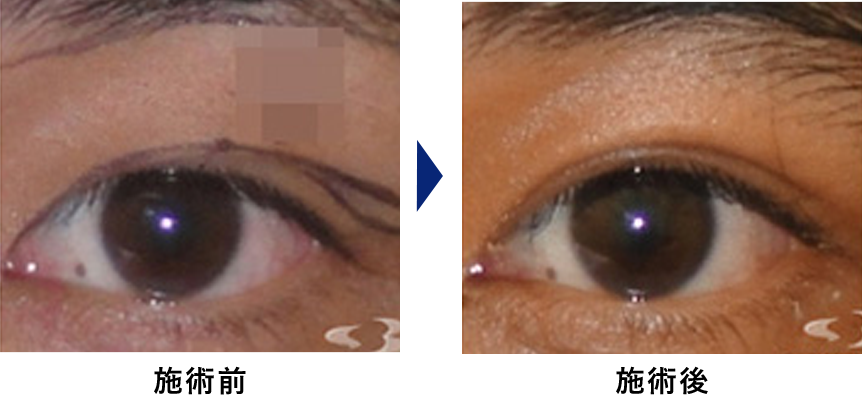 眼瞼下垂の症例写真3