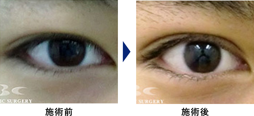 眼瞼下垂の症例写真4