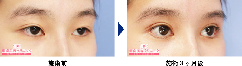 下眼瞼下制法(たれ目術)の症例写真ビフォーアフター2