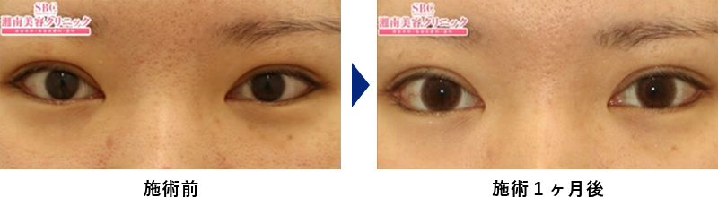 下眼瞼下制法(たれ目術)の症例写真ビフォーアフター3