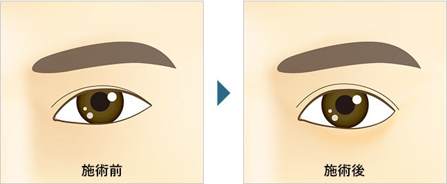 下眼瞼下制法・グラマラスライン形成
(たれ目術)とは