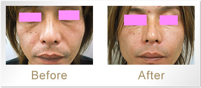 Before/After