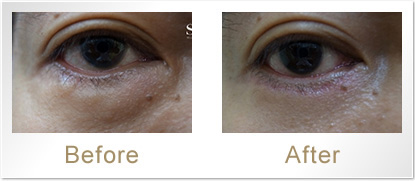 Before/After