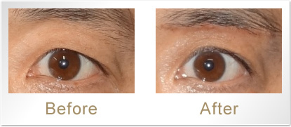 Before/After