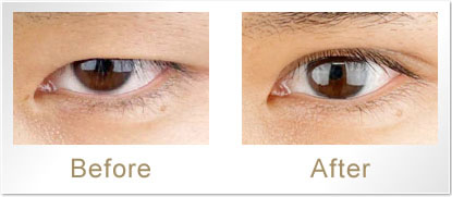 Before/After