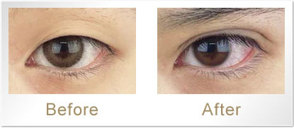 Before/After