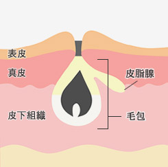 黒 ニキビ 治し 方