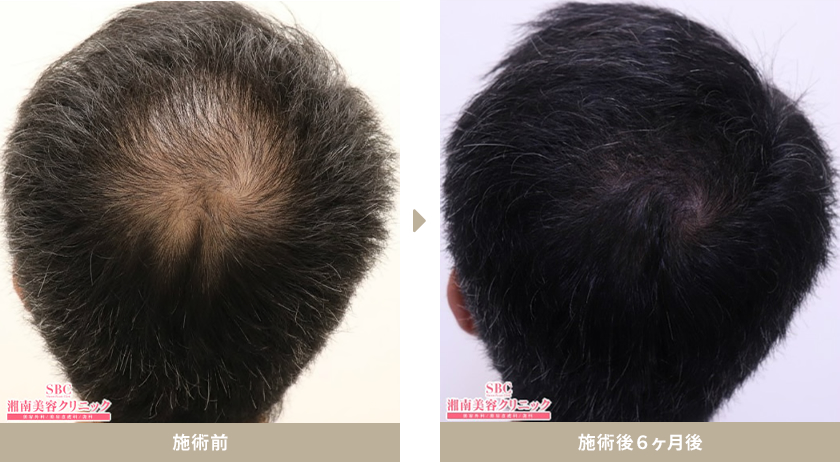 【AGA薄毛治療】50代男性 症例写真 施術前 施術後6ヶ月後