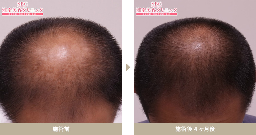 【AGA薄毛治療】40代男性 症例写真 施術前 施術後4ヶ月後