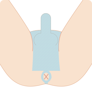 男性のハイジニーナ(VIO)