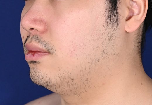 男性脱毛 ヒゲ02 症例写真 1回目照射から1か月後(剃毛していない状態)