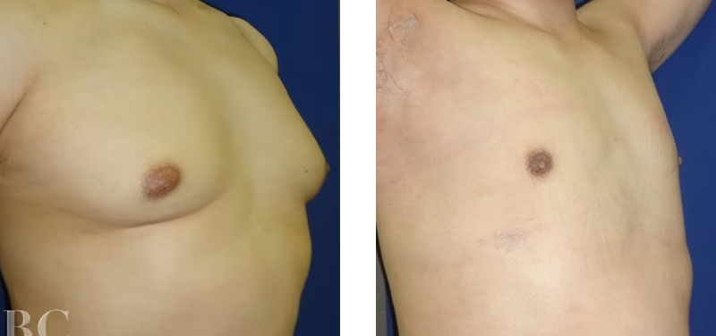 脂肪吸引の胸部写真ビフォーアフター