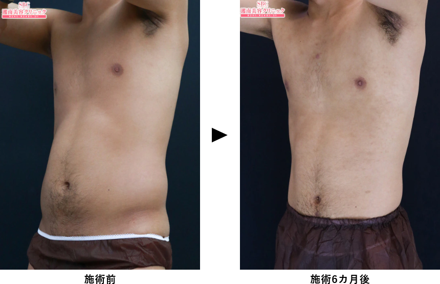 男性（メンズ）クールスカルプティング®エリート（クルスカダブル）の下腹部症例写真ビフォーアフター